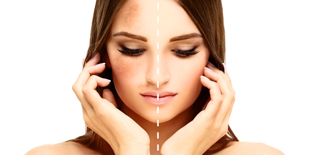 Addressing And Preventing Hyperpigmentation